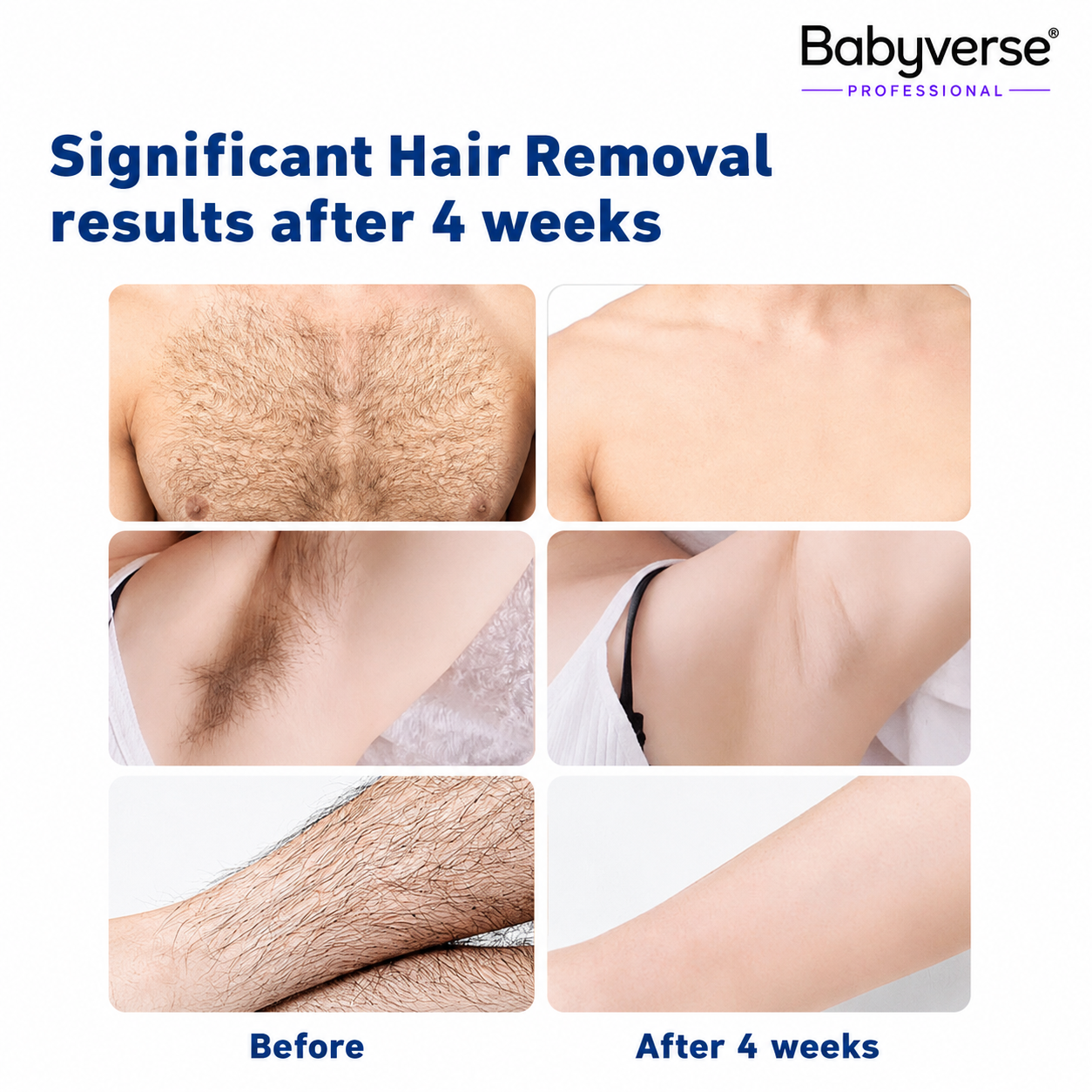 Babyverse IPL Hair Removal Device – Smooth Skin at Home